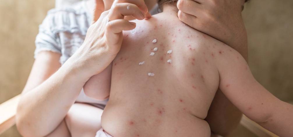 水痘疫苗 -- Yeung Ho Hong, 楊浩康